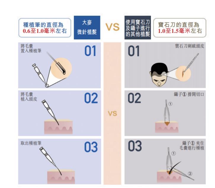 揭秘植发价格的真相，一个毛囊多少钱？